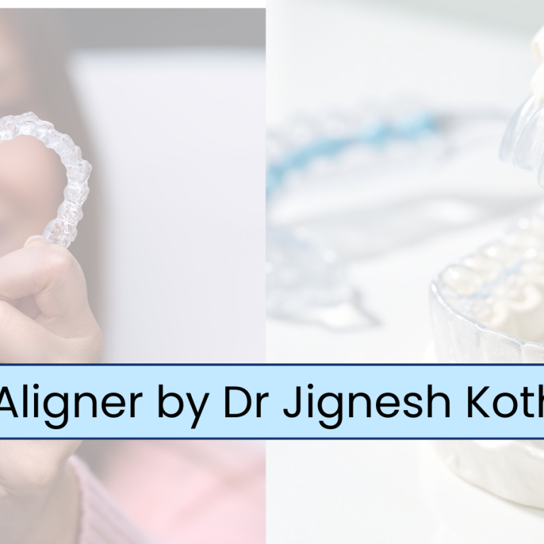 DIY Aligners – What is DIY Aligners _ By Dr. Jignesh Kothari