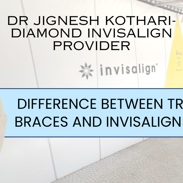 Difference between traditional braces and Invisalign aligners